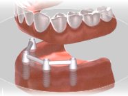 Zubní implantáty, CEREC korunky Zlín, Otrokovice