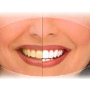 Ordinační bělení zubů - profesionální vybělení zubů